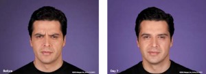 botox-6-300x109